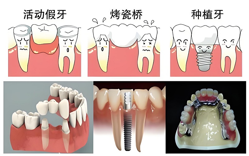 上海假牙加工安装种类及价格